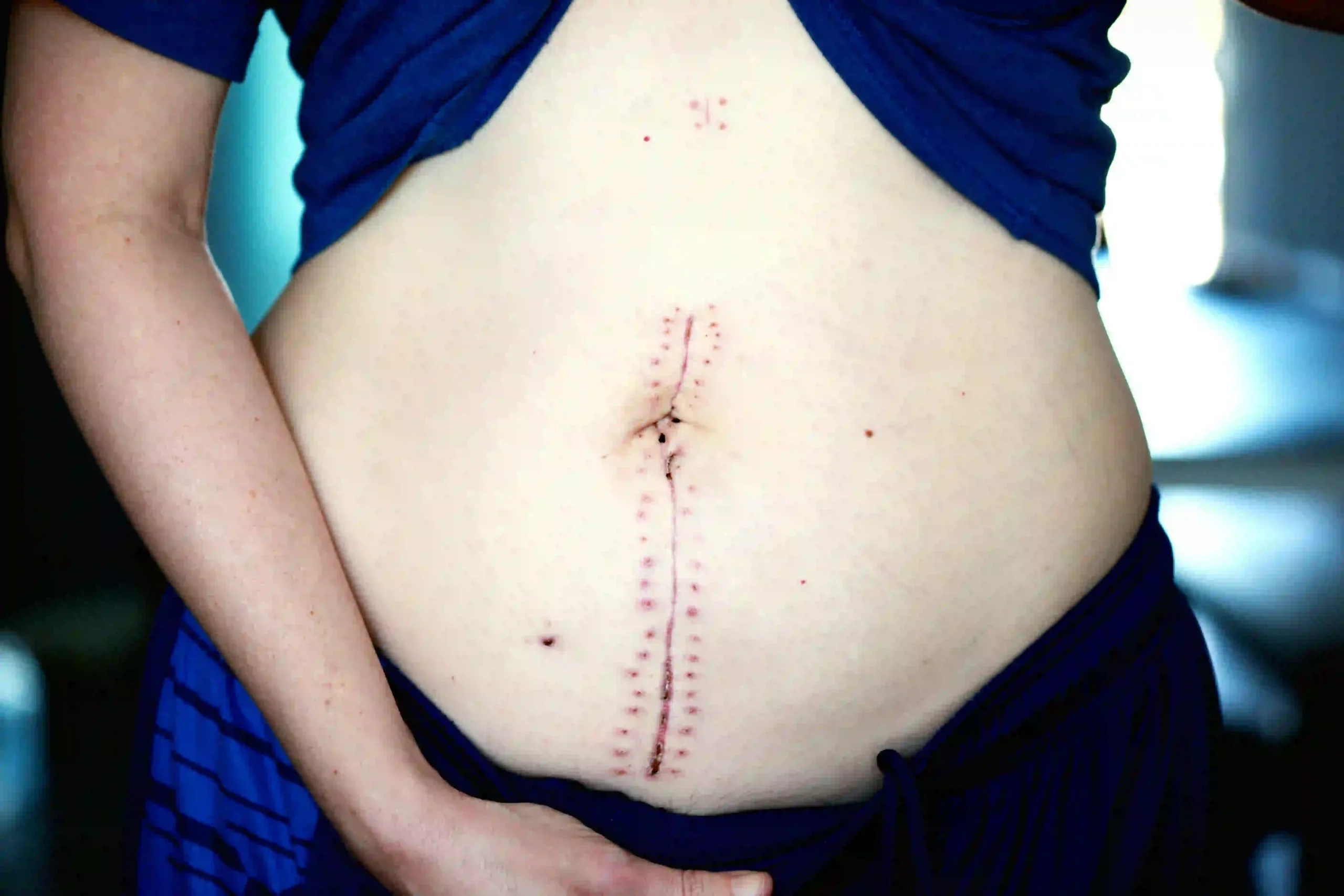 Wound Healing